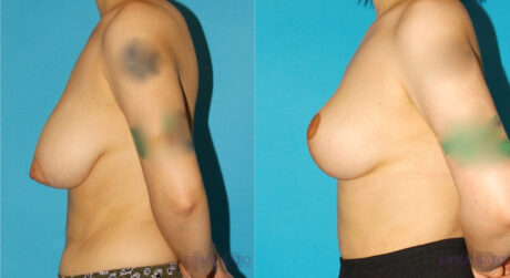 Breast Reduction case #7956
