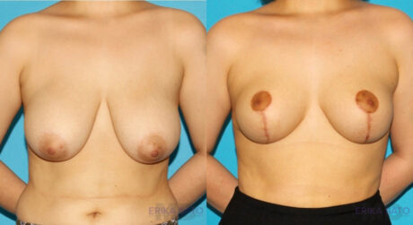 Breast Reduction case #7956