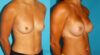 Breast Augmentation case #5997 slider thumbnail