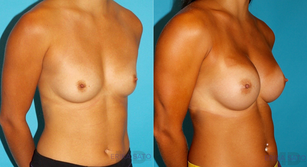 Breast Augmentation case #5997
