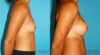 Breast Augmentation case #5997 slider thumbnail