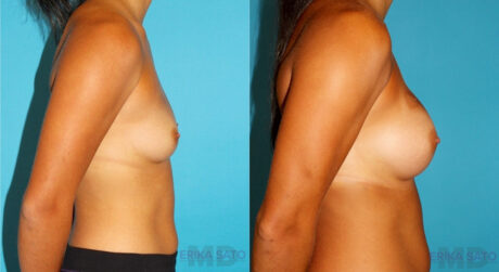 Breast Augmentation case #5997