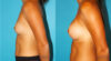 Breast Augmentation case #5997 slider thumbnail