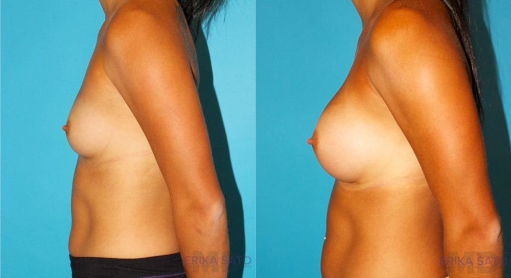 Breast Augmentation case #5997