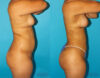 Brazilian Butt Lift case #4763 slider thumbnail