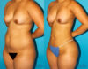 Brazilian Butt Lift case #4763 slider thumbnail
