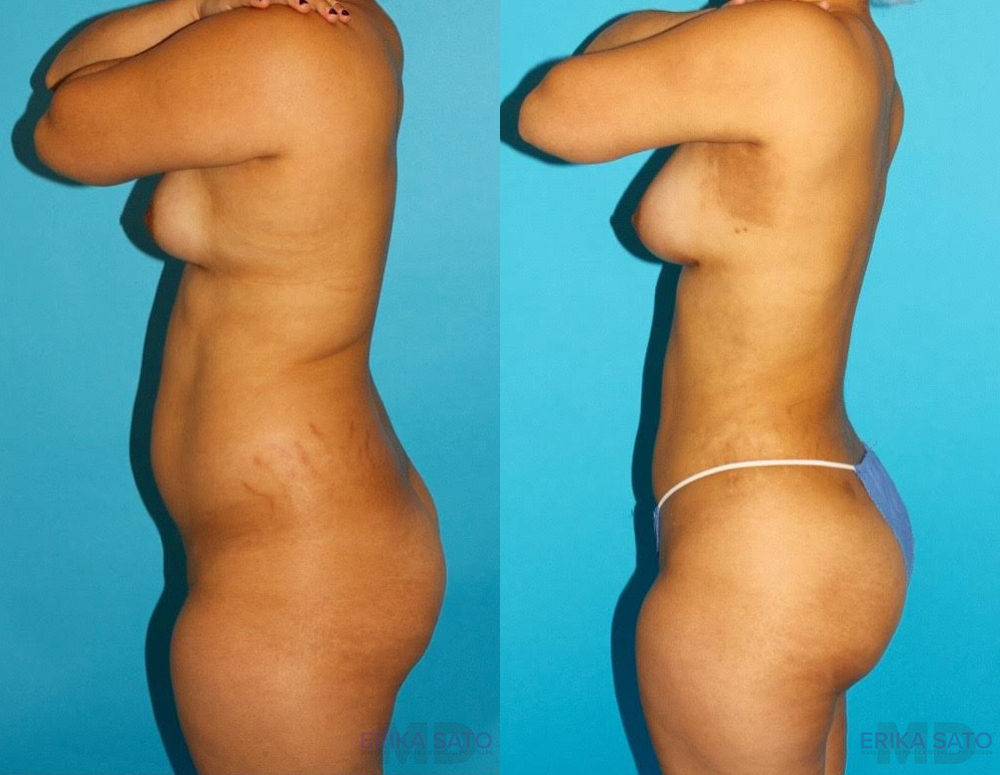 Brazilian Butt Lift case #4763