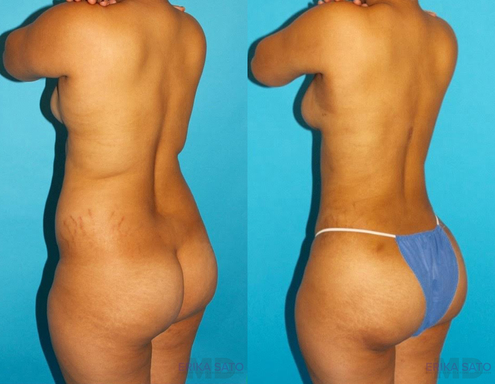 Brazilian Butt Lift case #4763