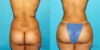 Brazilian Butt Lift case #4763 slider thumbnail