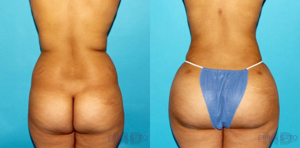 Brazilian Butt Lift case #4763