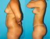 Brazilian Butt Lift case #4763 slider thumbnail