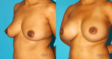 Breast Augmentation case #5678