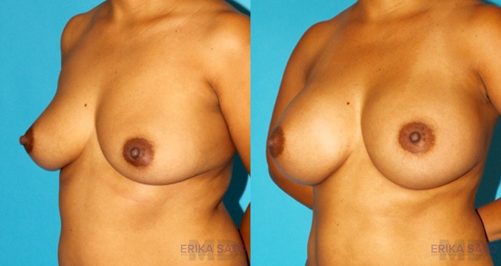 Breast Augmentation case #5678