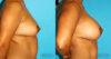 Breast Augmentation case #5678 slider thumbnail