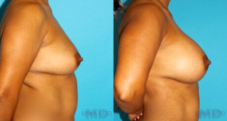 Breast Augmentation case #5678