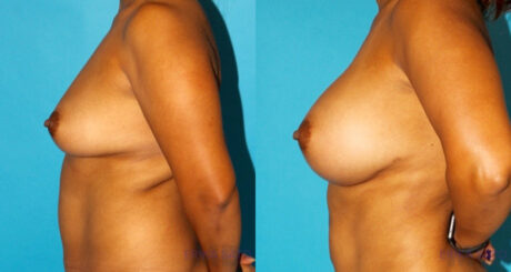 Breast Augmentation case #5678