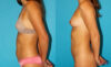 Liposuction case #5889 slider thumbnail