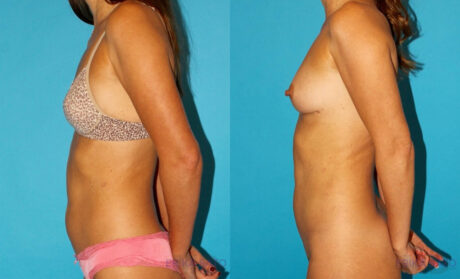 Liposuction case #5889
