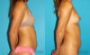Liposuction case #5889 slider thumbnail