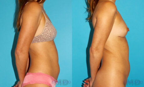 Liposuction case #5889
