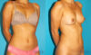 Liposuction case #5889 slider thumbnail