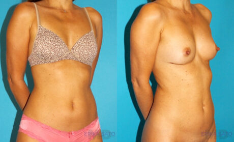 Liposuction case #5889