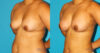 Fat Grafting to the Breast case #256162 slider thumbnail