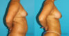 Fat Grafting to the Breast case #256162 slider thumbnail