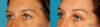 Blepharoplasty case #6890 slider thumbnail