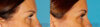 Blepharoplasty case #6890 slider thumbnail