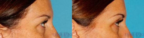 Blepharoplasty case #6890