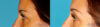 Blepharoplasty case #6890 slider thumbnail