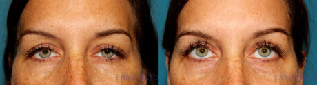 Blepharoplasty case #6890