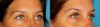 Blepharoplasty case #6890 slider thumbnail