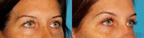 Blepharoplasty case #6890