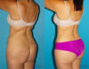 Tummy Tuck case #7169 slider thumbnail