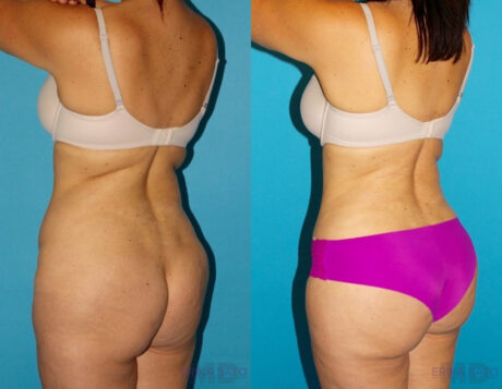 Tummy Tuck case #7169