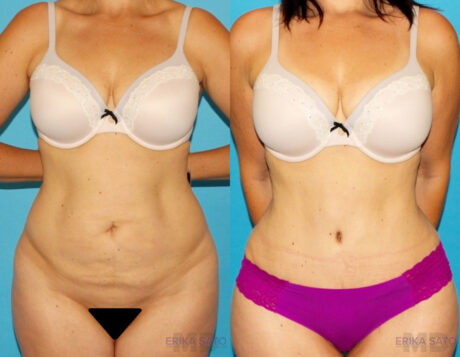 Tummy Tuck case #7169