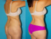 Tummy Tuck case #7169 slider thumbnail