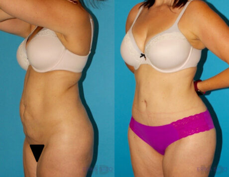 Tummy Tuck case #7169