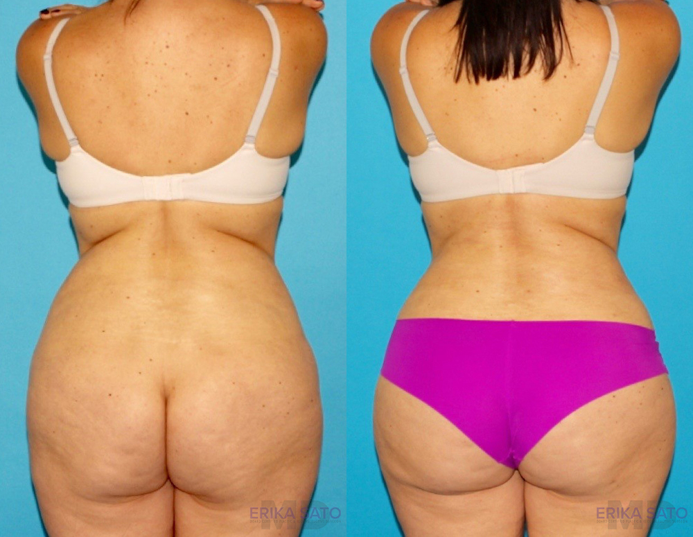 Tummy Tuck case #7169