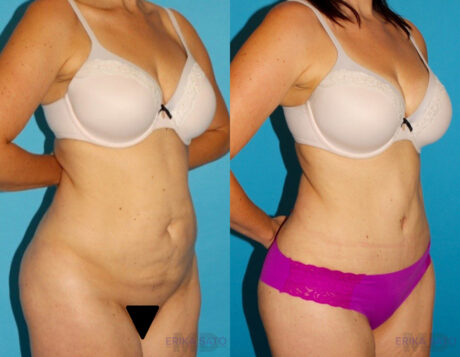 Tummy Tuck case #7169