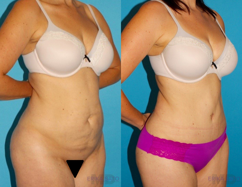 Tummy Tuck case #7169