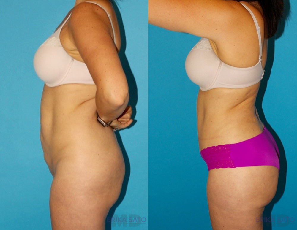 Tummy Tuck case #7169
