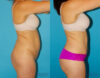 Tummy Tuck case #7169 slider thumbnail