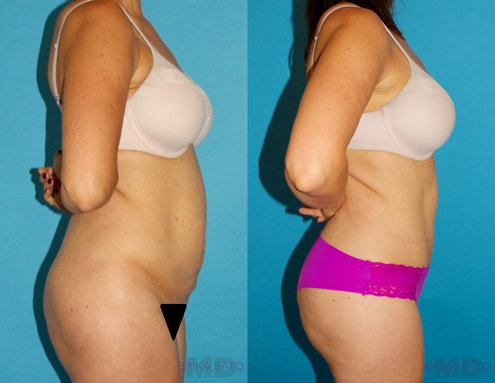Tummy Tuck case #7169