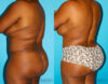 Brazilian Butt Lift case #4513 slider thumbnail