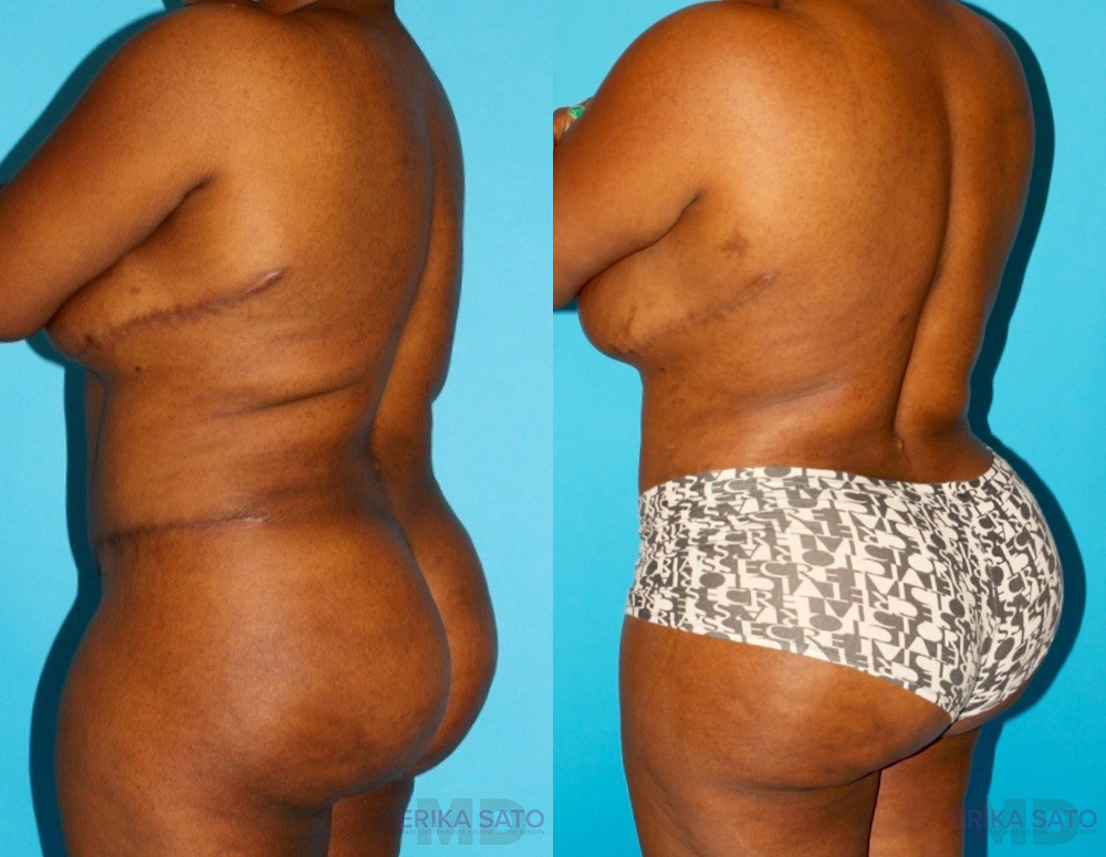 Brazilian Butt Lift case #4513