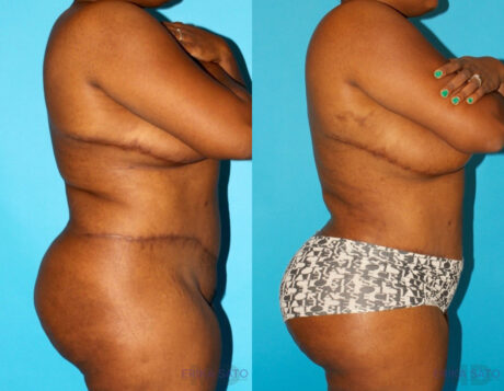 Brazilian Butt Lift case #4513