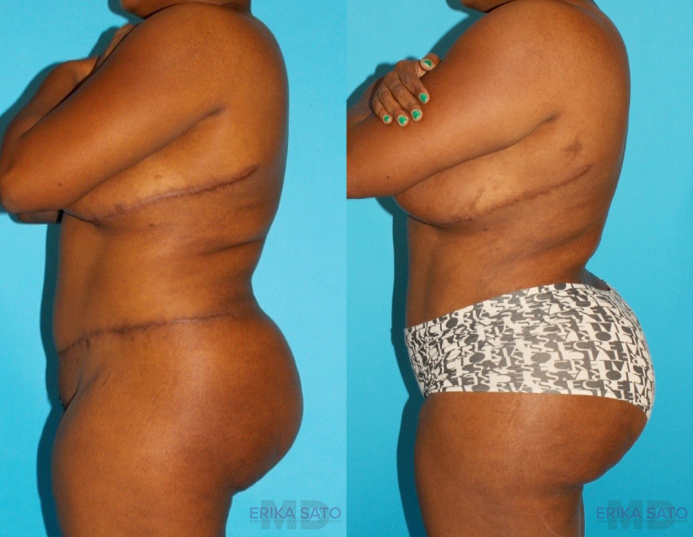 Brazilian Butt Lift case #4513